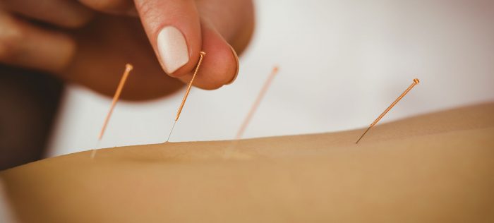 Acupuncture